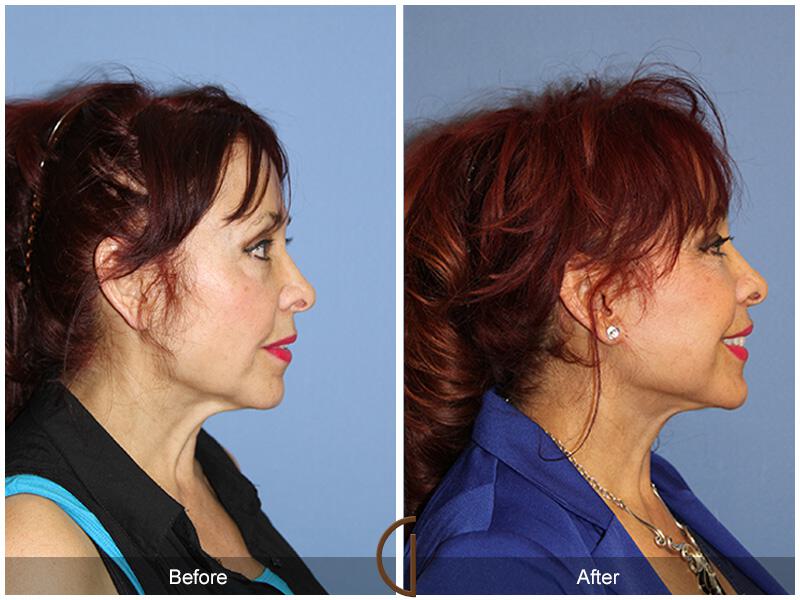 Facelift Sixties Before & After Photo