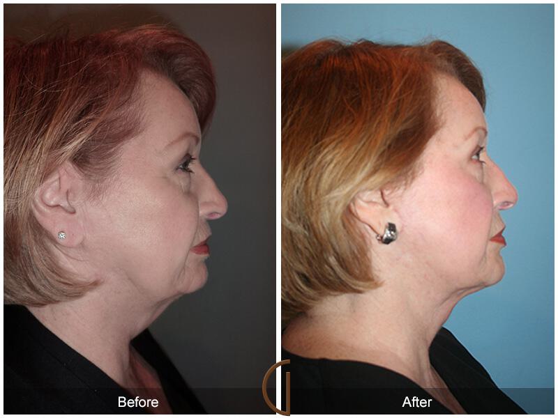 Facelift Sixties Before & After Photo