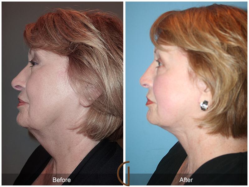 Facelift Sixties Before & After Photo