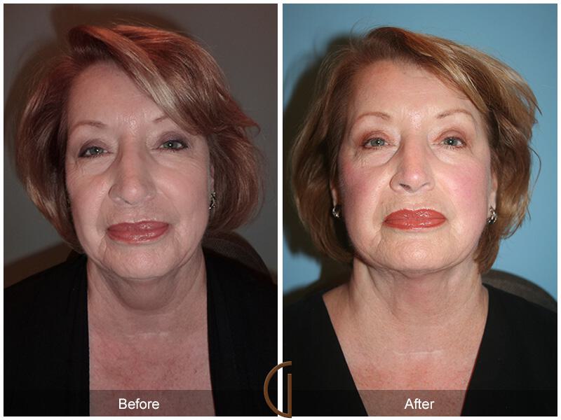 Facelift Sixties Before & After Photo