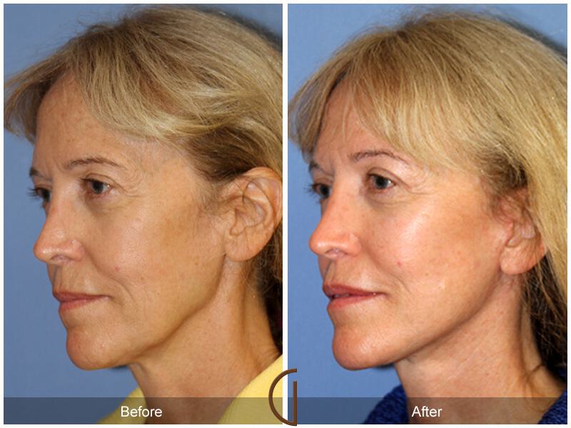 Facelift Sixties Before & After Photo