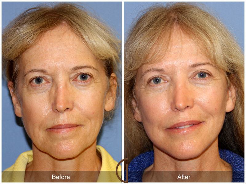 Facelift Sixties Before & After Photo