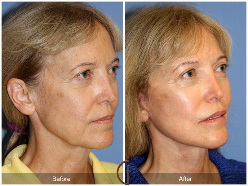 Facelift Sixties Before & After Photo