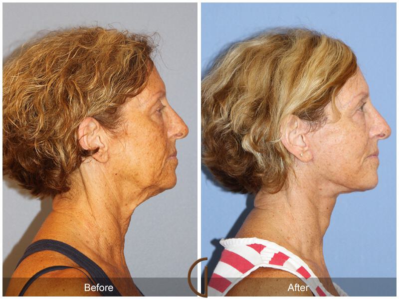 Facelift Sixties Before & After Photo