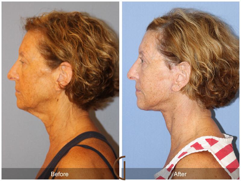 Facelift Sixties Before & After Photo