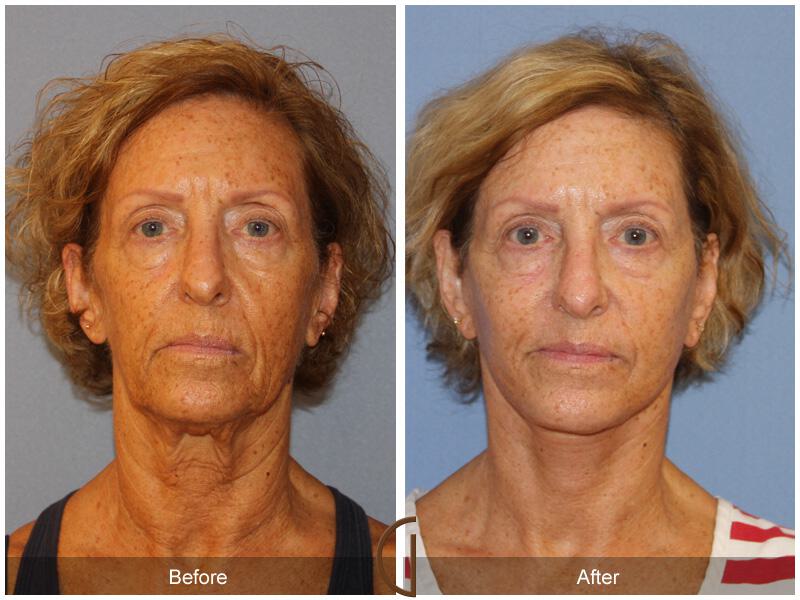 Facelift Sixties Before & After Photo