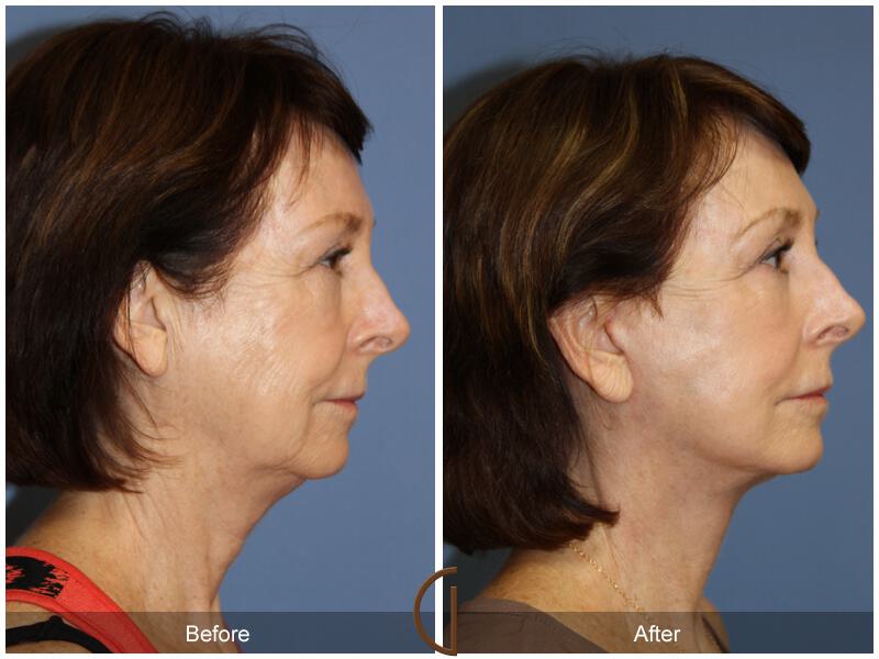 Facelift Sixties Before & After Photo