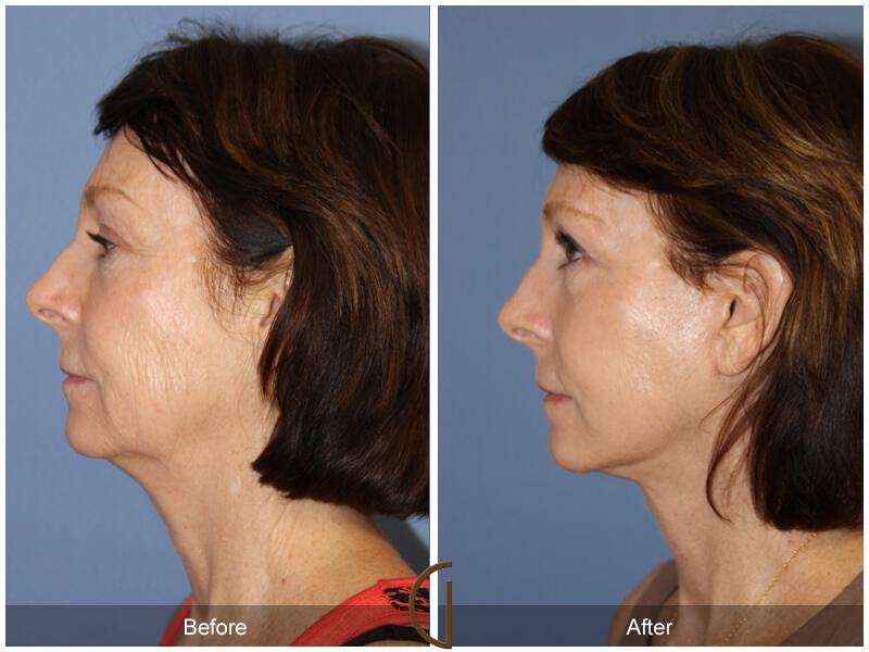 Facelift Sixties Before & After Photo