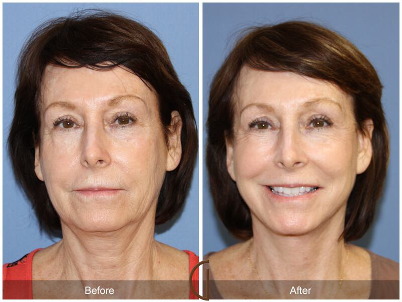 Facelift Sixties Before & After Photo