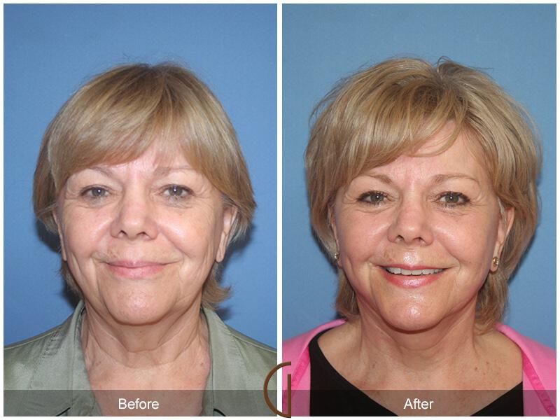 Facelift Sixties Before & After Photo