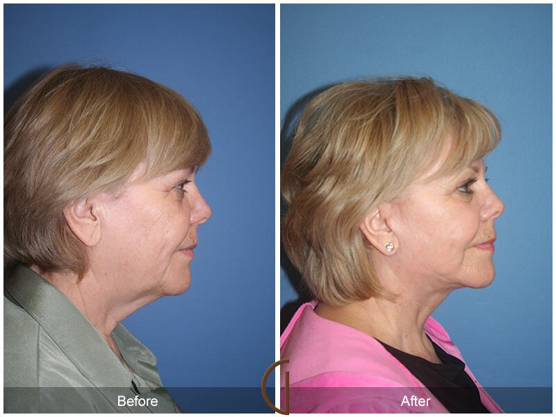 Facelift Sixties Before & After Photo