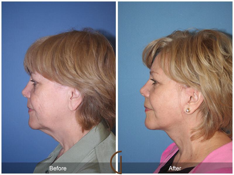 Facelift Sixties Before & After Photo