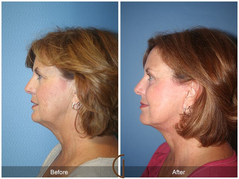 Facelift Sixties Before & After Photo