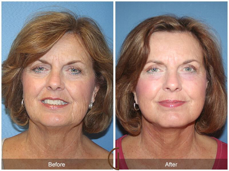 Facelift Sixties Before & After Photo