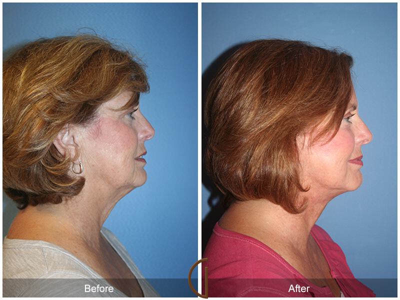 Facelift Sixties Before & After Photo