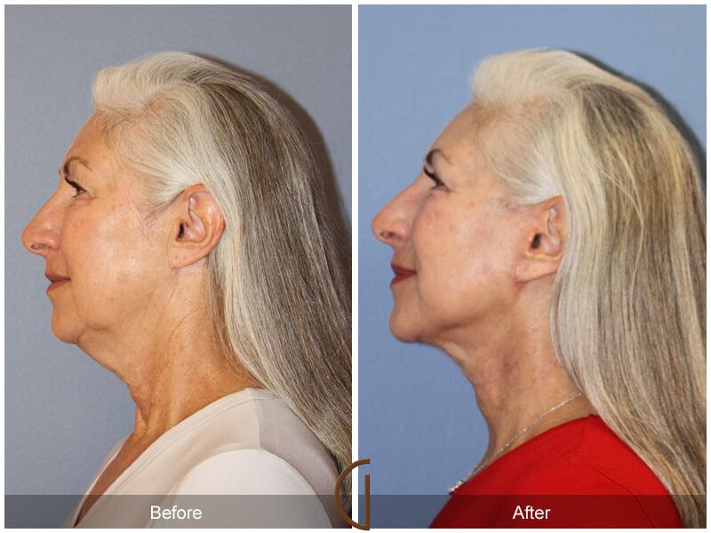 Facelift Sixties Before & After Photo