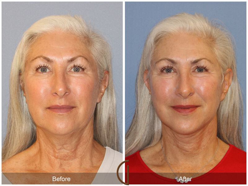 Facelift Sixties Before & After Photo