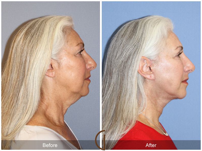 Facelift Sixties Before & After Photo