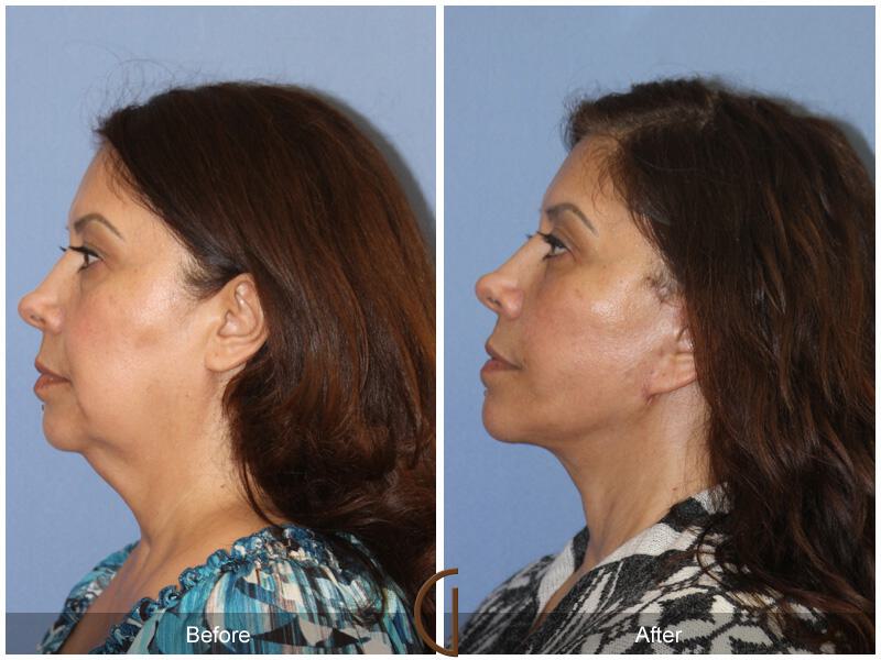 Facelift Sixties Before & After Photo