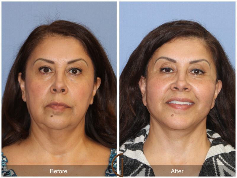 Facelift Sixties Before & After Photo