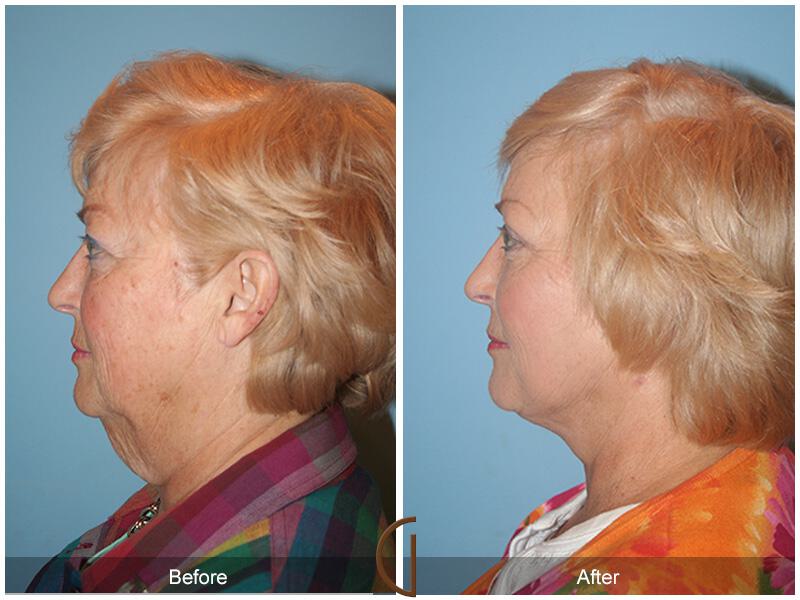 Facelift Sixties Before & After Photo