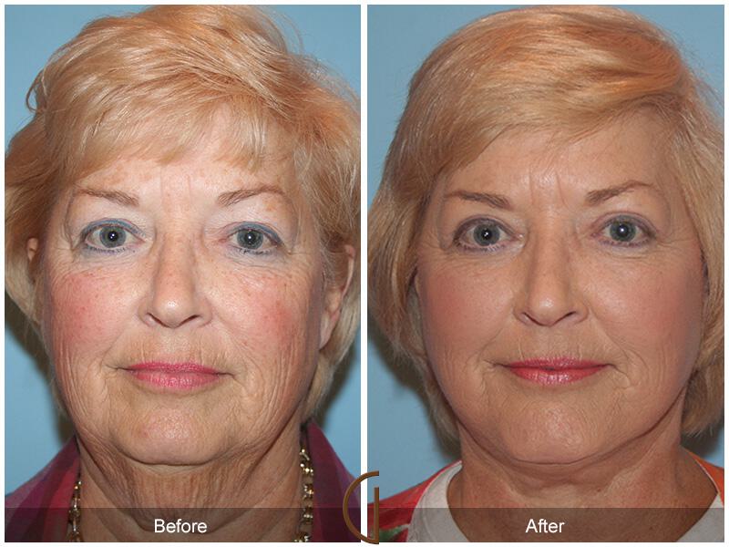 Facelift Sixties Before & After Photo