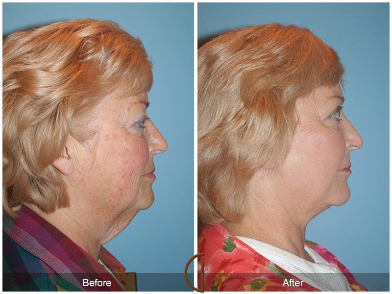 Facelift Sixties Before & After Photo