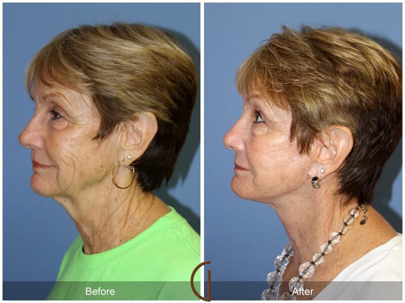 Facelift Sixties Before & After Photo