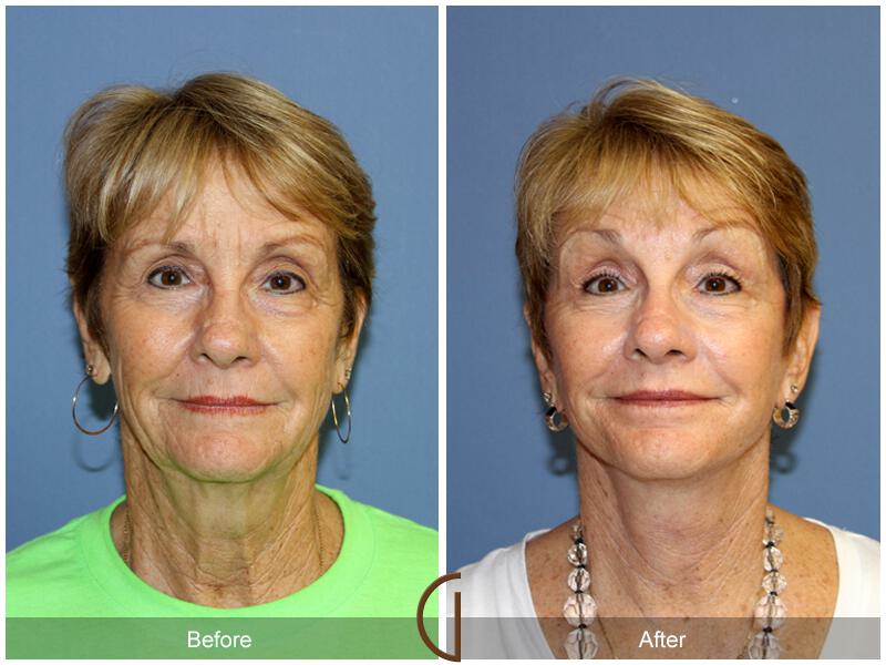 Facelift Sixties Before & After Photo