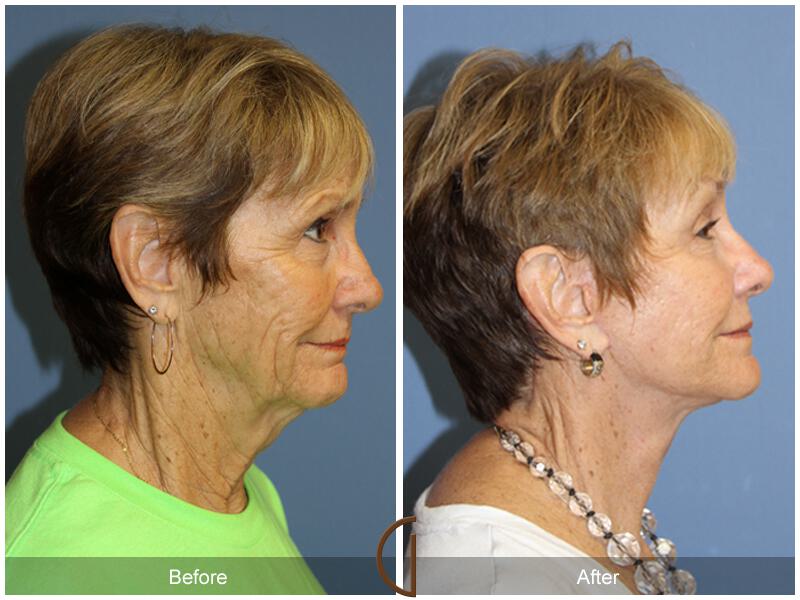 Facelift Sixties Before & After Photo