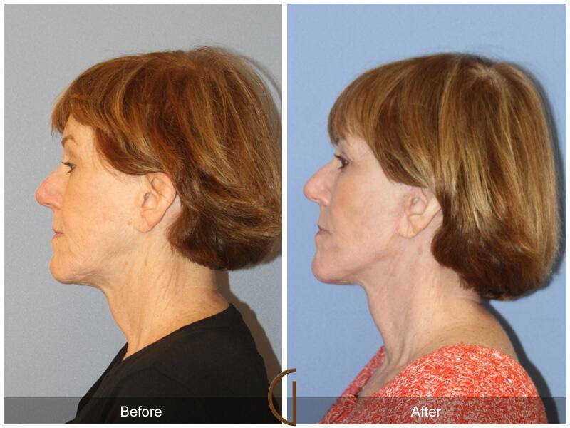 Facelift Sixties Before & After Photo