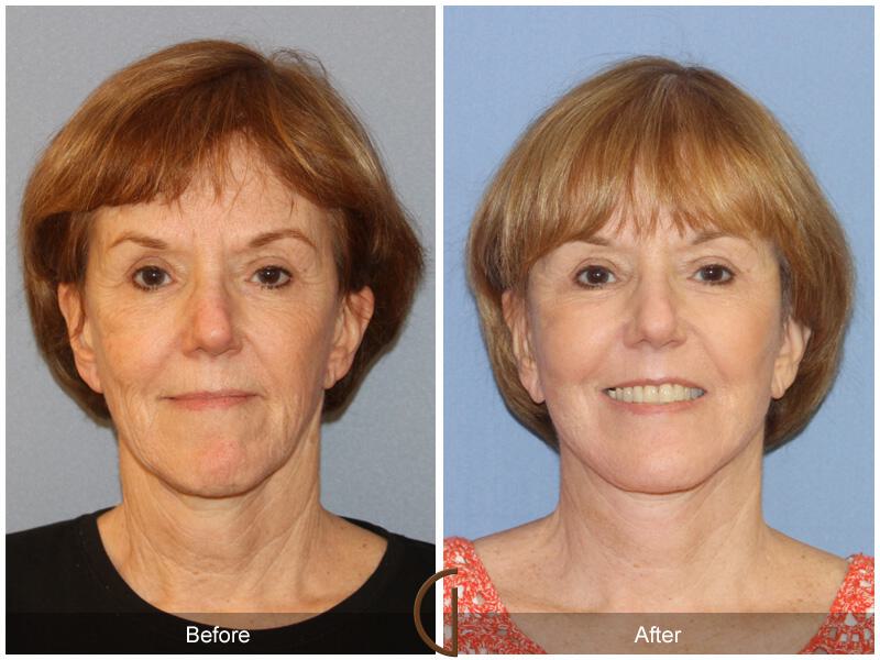 Facelift Sixties Before & After Photo