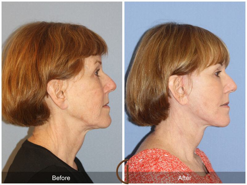 Facelift Sixties Before & After Photo