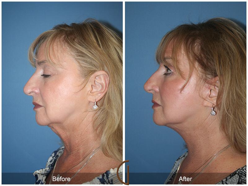 Facelift Sixties Before & After Photo