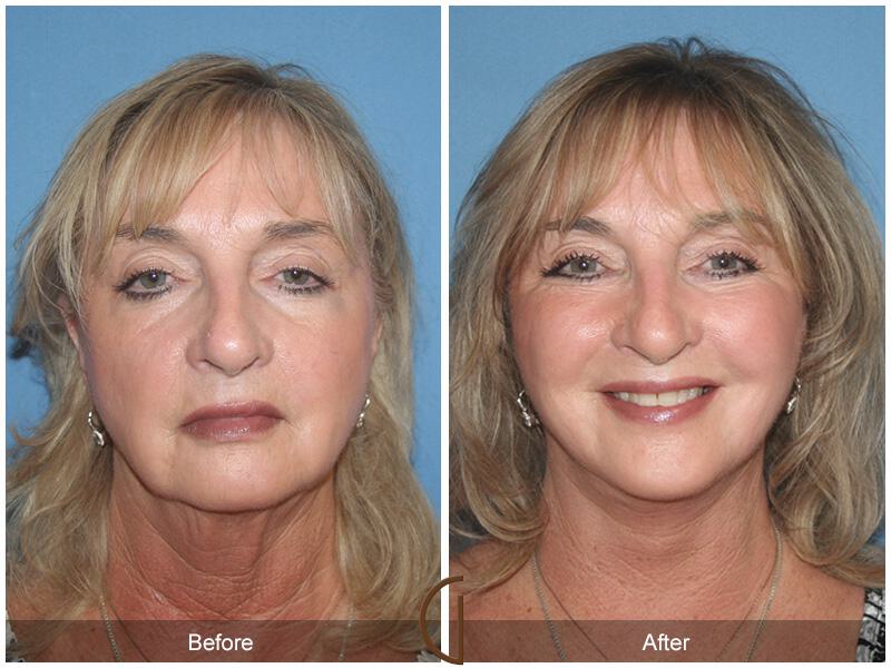 Facelift Sixties Before & After Photo