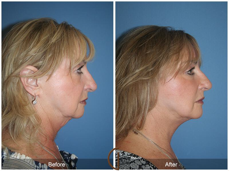 Facelift Sixties Before & After Photo