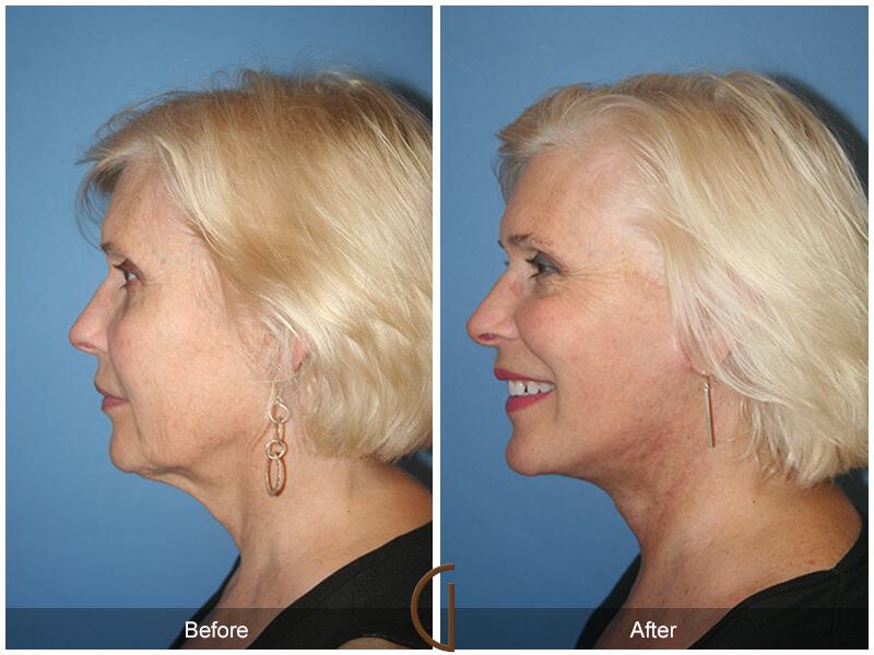 Facelift Sixties Before & After Photo