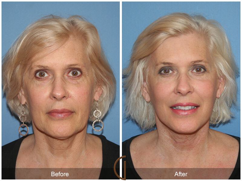 Facelift Sixties Before & After Photo