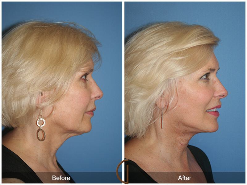 Facelift Sixties Before & After Photo