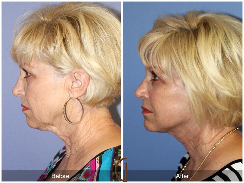 Facelift Sixties Before & After Photo