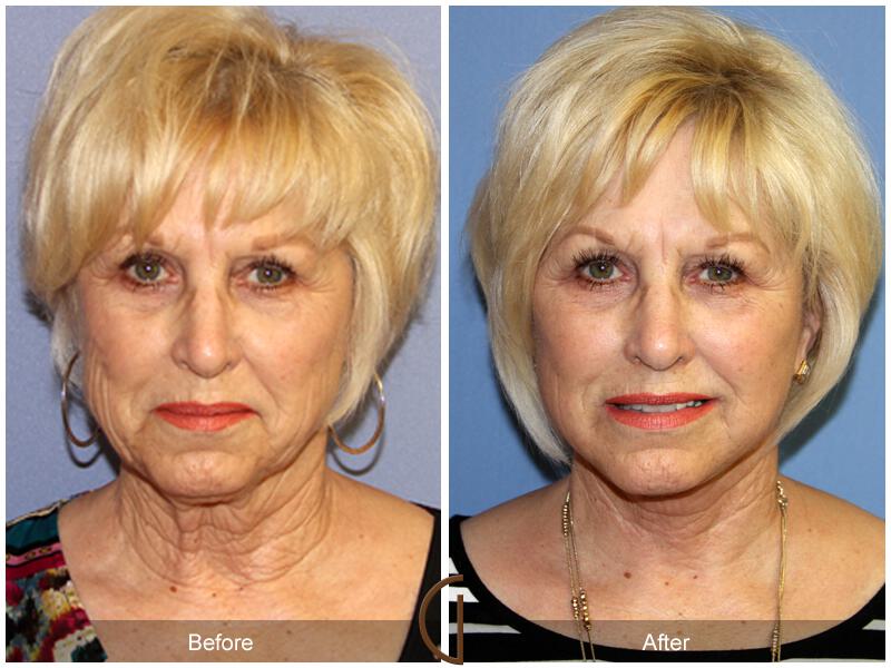 Facelift Sixties Before & After Photo