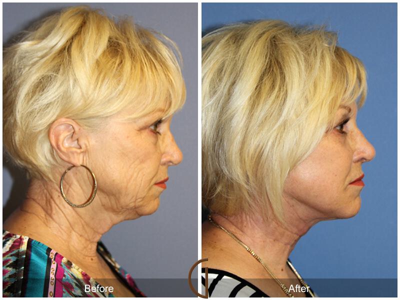 Facelift Sixties Before & After Photo