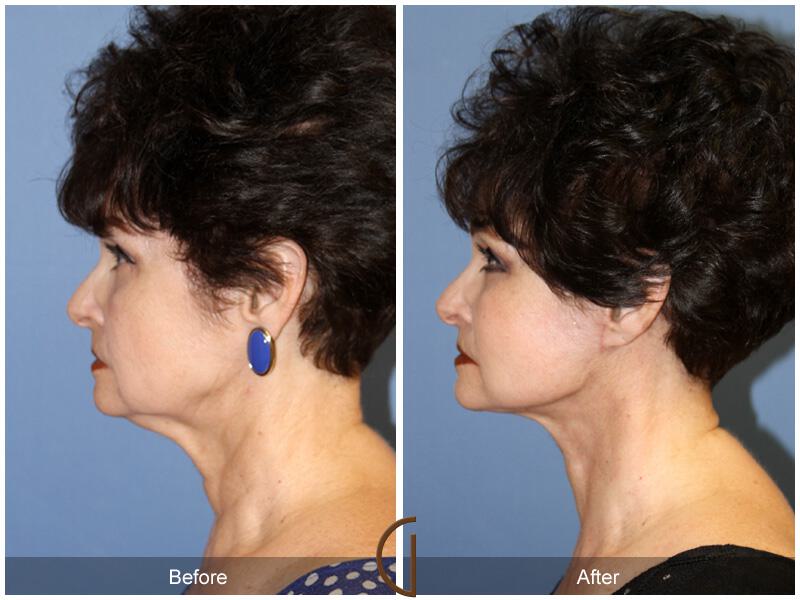 Facelift Sixties Before & After Photo