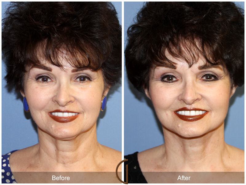 Facelift Sixties Before & After Photo