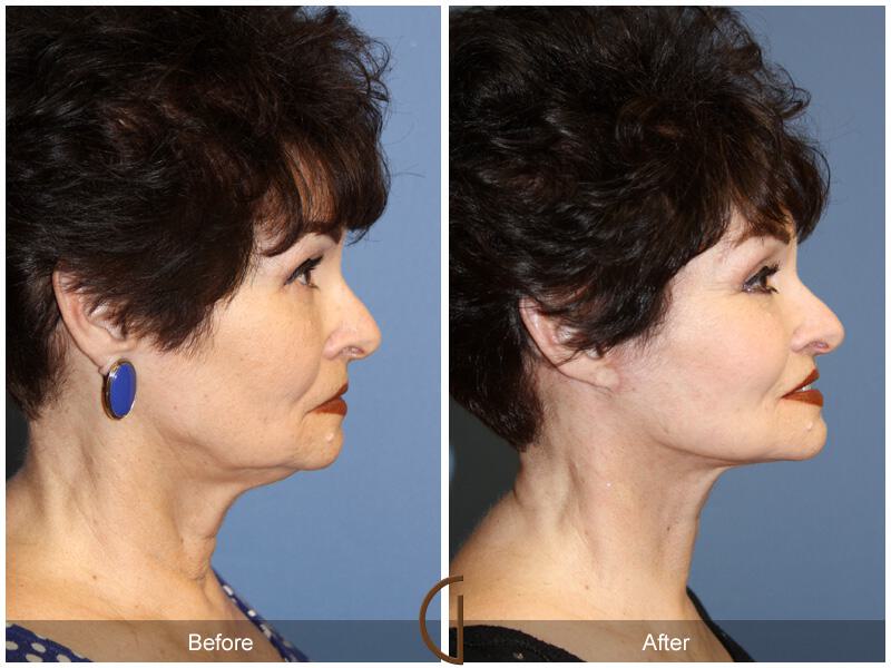 Facelift Sixties Before & After Photo