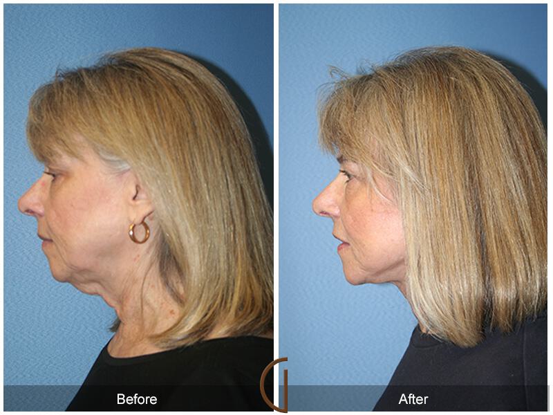 Facelift Sixties Before & After Photo