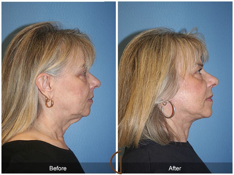 Facelift Sixties Before & After Photo