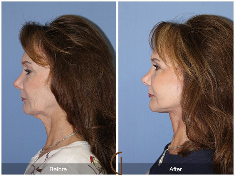 Facelift Sixties Before & After Photo