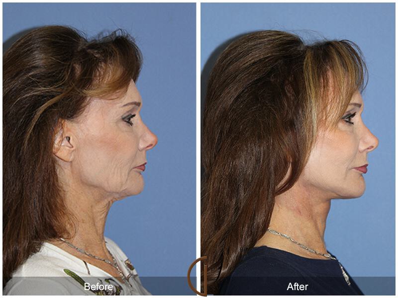 Facelift Sixties Before & After Photo