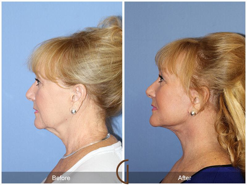 Facelift Sixties Before & After Photo